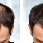 Hair Loss treatments Webster Tx