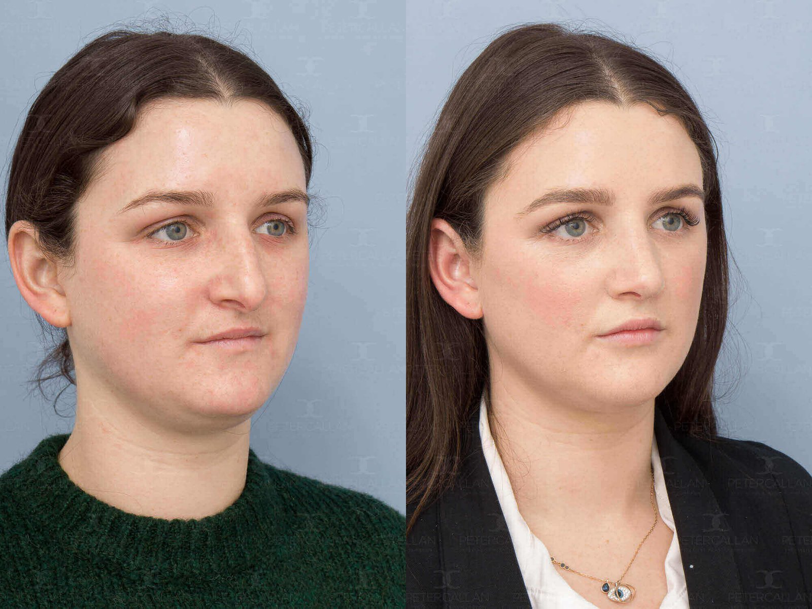 Non-surgical nose job